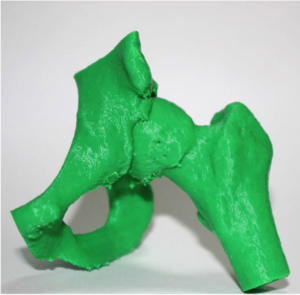 Ortopedia e impressão 3D: utilizações e exemplos práticos